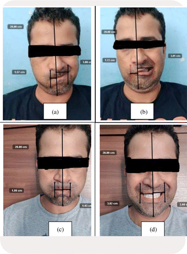 Motor points of face for electrical stimulation of bell's palsy