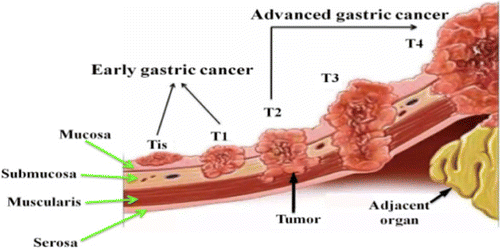 submucosal gastric lesion