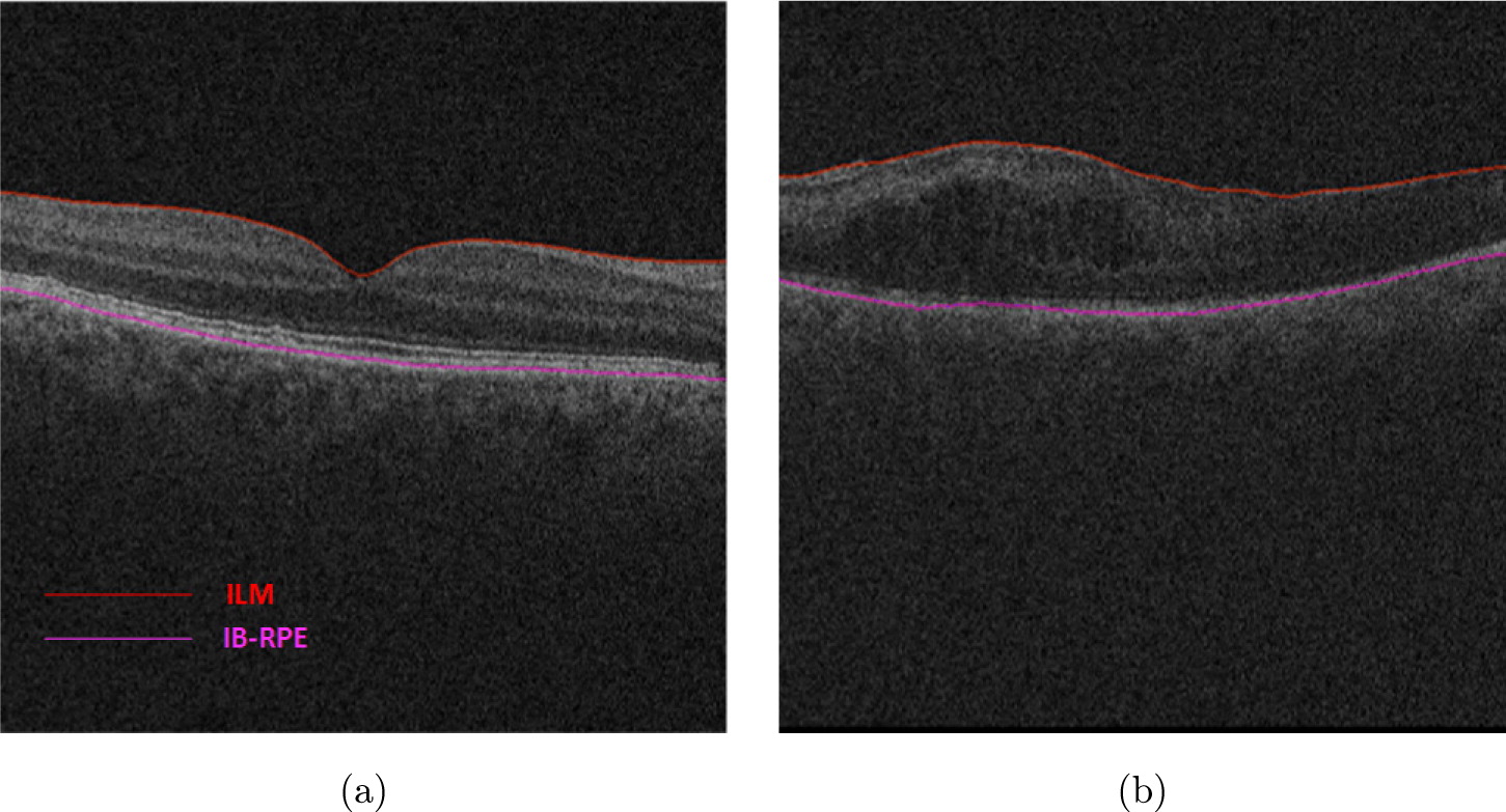 Automated segmentation of intraretinal cystoid macular edema based on ...