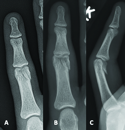 middle phalanx fracture
