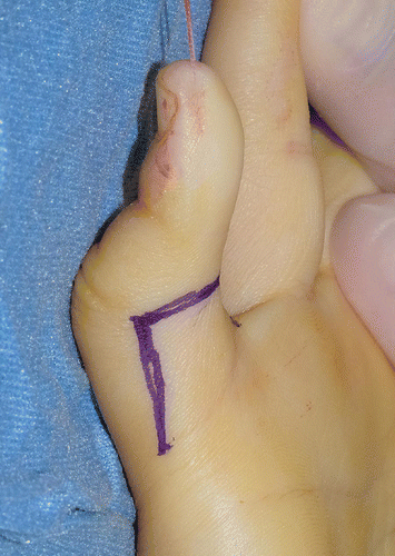 Camptodactyly (Bent Fingers) In Children - Macomb Hand Surgery