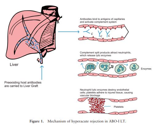 Liver Transplantation